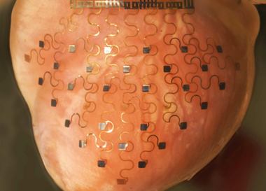  Появился имплантат предотвращающий сердечные приступы с помощью смартфона